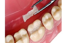رزین‌های دندانی ضدباکتری ساخته شد