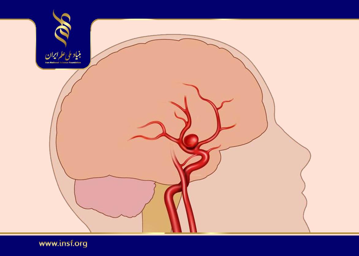 تحلیل عددی آنوریسم در شریان‌های مغزی با رویکردی مبتنی بر خواص مکانیکی بافت